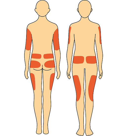 Injection sites
